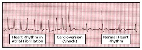 Cardioversion | Heart Rhythm Society