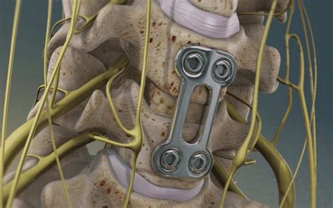 ACDF Surgery - ONZ Spine