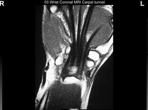 03 Wrist Coronal MRI - Carpal Tunnel Diagram | Quizlet