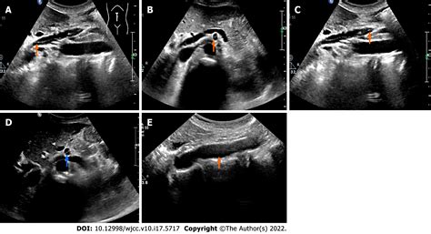 Inferior Mesenteric Artery Ultrasound