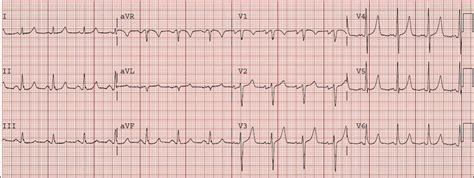 Dr. Smith's ECG Blog: HyperKalemia with Cardiac Arrest. Peaked T waves: Hyperacute (STEMI) vs ...