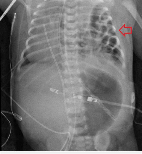 Chest X-ray of the congenital diaphragmatic hernia (arrow) | Download Scientific Diagram