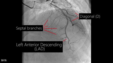 Coronary artery anatomy - Coronary angiogram - YouTube