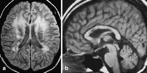 [PDF] Acquired lesions of the corpus callosum: MR imaging | Semantic ...