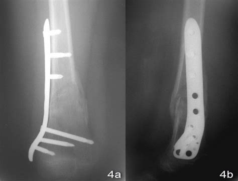 X-ray of right knee showed united fracture. | Download Scientific Diagram