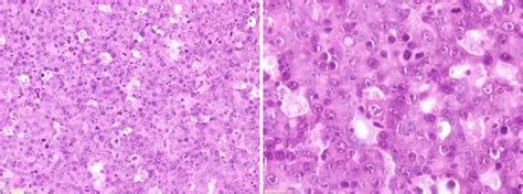 A patient with plasmablastic lymphoma achieving long-term complete remission after thalidomide ...