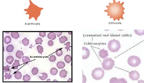 Spur Cell (Acanthocyte) And Burr Cell (Echinocyte), 48% OFF