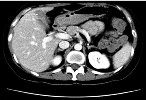 Surveillance computed tomography scan showing hypodense lesion in... | Download Scientific Diagram