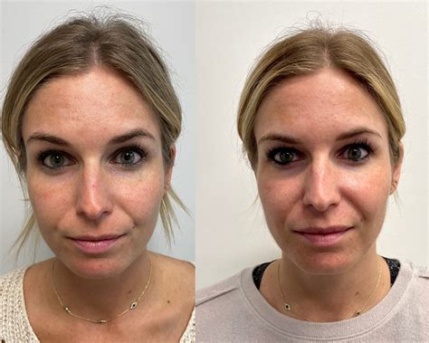 MELASMA TREATMENTS – One Small Blonde | Dallas Fashion Blogger