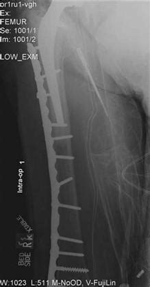 Periprosthetic Fracture: Prevention/Diagnosis/Treatment ...