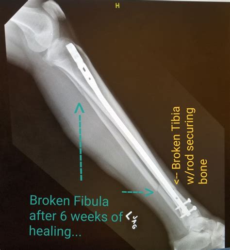 Pin on Broken Tibia & Fibula blues 2 bones & 3 breaks