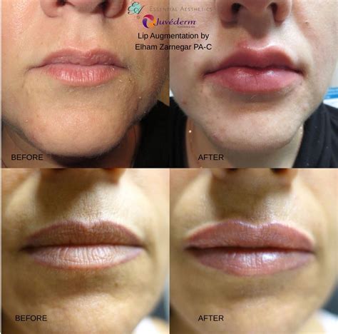 Juvederm adds volume to the lips and smooths verticals lip lines ...