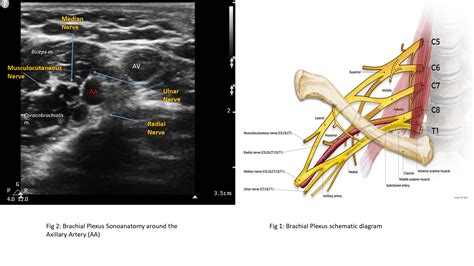 Axillary Block Article - StatPearls