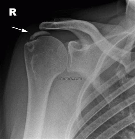 Calcific Tendonitis | Arm Docs