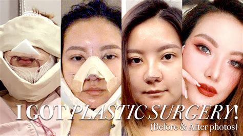 I Got Plastic Surgery in Korea: Part 2 ⎮BEFORE & AFTER, SURGERY ...