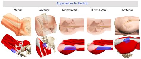 Posterior vs anterior hip replacement | doctorvisit