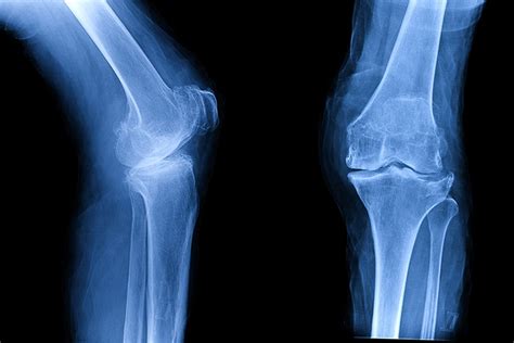 Update: Osteoarthritis and Spondylosis, Active Component, U.S. Armed Forces, 2016–2020 | Health.mil