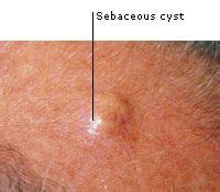 There are some tips that work for #Sebaceous #Cyst! | Home remedies for ...