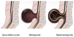 Spina Bifida - Physiopedia