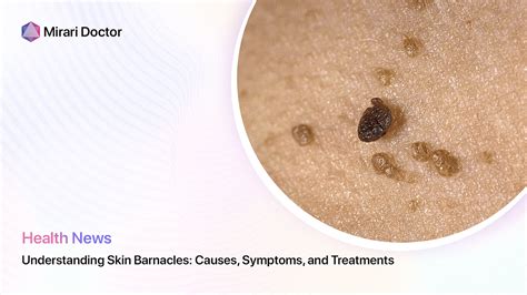 Understanding Skin Barnacles: Causes, Symptoms, and Treatments | by ...