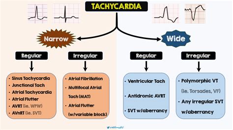 Ventricular Tachycardia Causes Diagnosis And Treatment