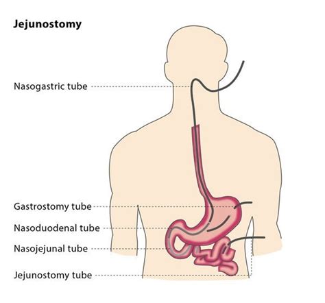 Jejunostomy – CIRSE