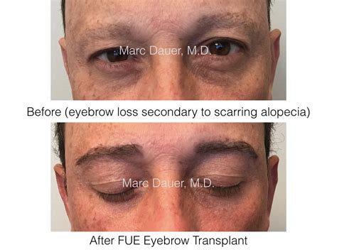 FUE Eyebrow Transplant In A Male Patient With Scarring Alopecia | Marc Dauer, MD Hair Transplant ...