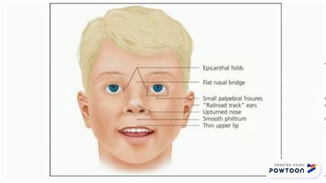 Structural chromosomal abnormalities; Cri du chat, Angelsman's and Willi Prader syndromes - YouTube