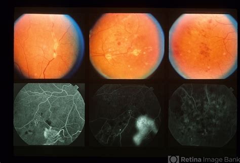 Eales Disease - Retina Image Bank