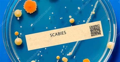 Scabies parasitic infection - Stock Image - F042/0263 - Science Photo Library