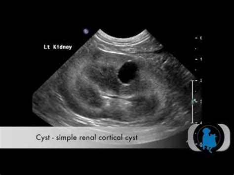 Renal Cortical Cyst