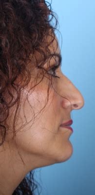 Rhinoplasty Archives - North Texas Plastic Surgery