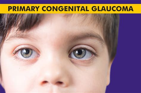 What is Congenital Glaucoma ? | Centre For Sight