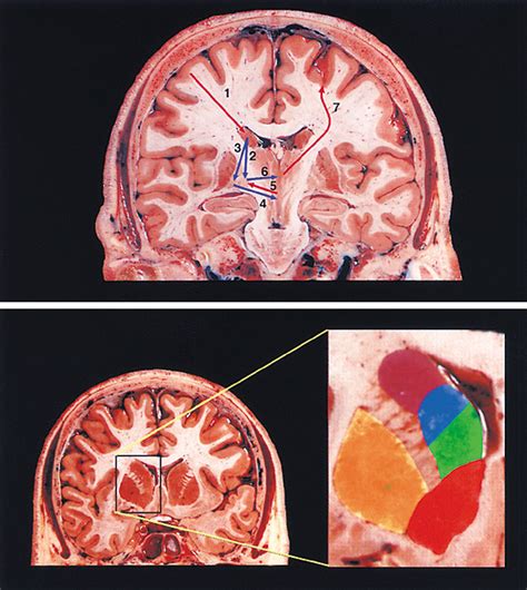 Neuropsychiatric Assessment of Patients With Hyperkinetic and ...