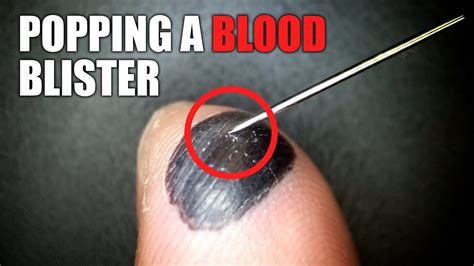 Should You Pop A Burn Blister