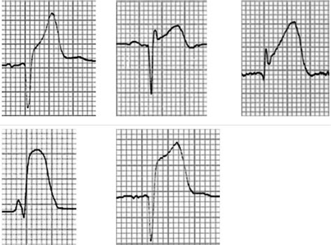 The ST Segment • LITFL • ECG Library Basics