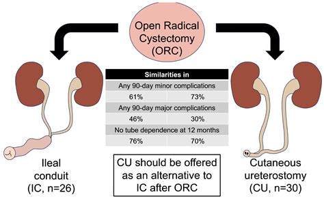 Ureterostomy Tube