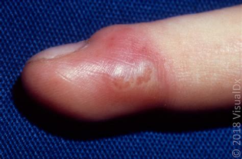 Acute Hand Infections | AAFP