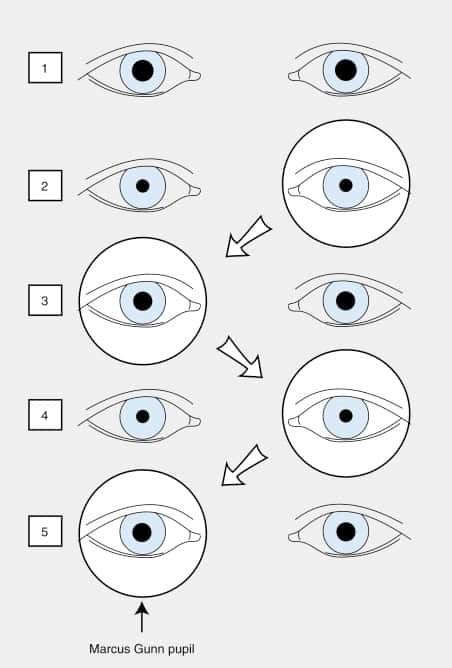 Relative Afferent Pupillary Defect (RAPD) | STROKE MANUAL