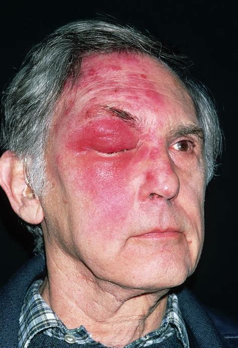 Shingles Attack On Head Of Elderly Male Photograph by Dr P. Marazzi/science Photo Library