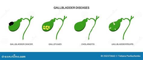 Gallbladder Polyp Anatomy Cartoon Vector | CartoonDealer.com #252057917