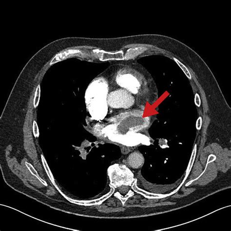 CT pulmonary angiography (CTPA) showinga bilateral pulmonary embolisms... | Download Scientific ...