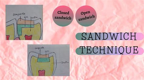 QUICK AND DETAILED EXPLANATION OF SANDWICH TECHNIQUE OF RESTORATION | COMPOSITES | DENTO FRIEND ...