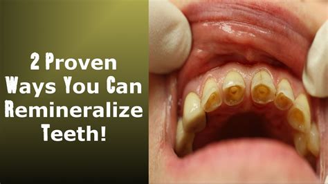 2 Little Known Ways To Achieve Tooth Remineralization: Easy To ...