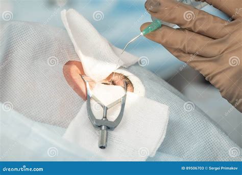 Crystalline Lens Replaceable Surgical Method Stock Image - Image of ophthalmology, macula: 89506703