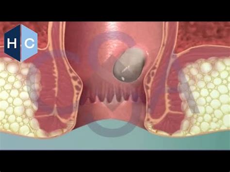 Internal & External Hemorrhoids - Colorectal Surgical Associates ...