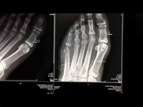 Bone Infection And Osteomyelitis In Diabetes Patient - Foot X-ray And MRI • Video • MEDtube.net