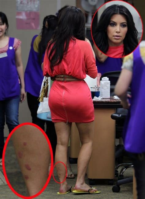 Photo : Kim Kardashian a du psoriasis à Los Angeles en juillet 2011 ...