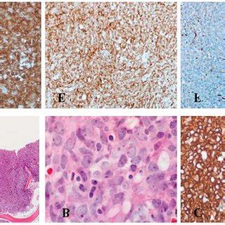 Bone marrow trephine biopsy results. Morphology and... | Download ...