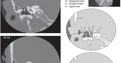 Temporal Bone - CT Scan - RadTechOnDuty